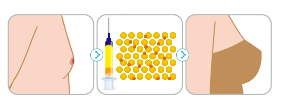 自体脂肪,隆胸,长春好的整形医院