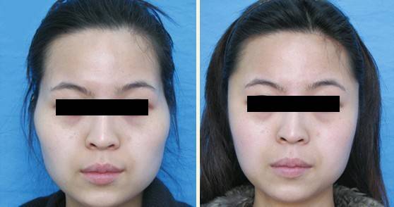 自体脂肪,填充面部,对比图,长春好的整形医院