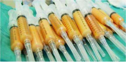 自体脂肪,填充面部,对比图,长春好的整形医院