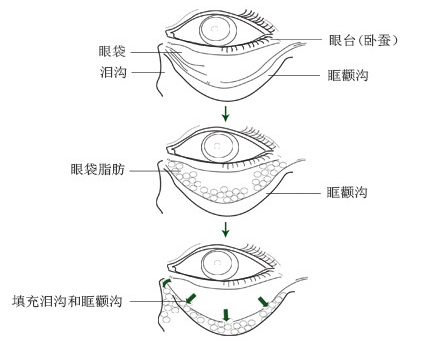 祛眼袋手术,图示,长春好的整形医院