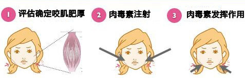 瘦脸针,瘦腿针,长春好的整形医院