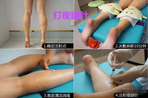 瘦脸针,瘦腿针,长春好的整形医院