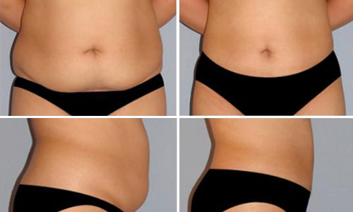 产后吸脂,对比图,长春好的整形医院