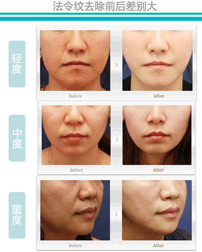电波拉皮,法令纹,对比图,长春好的整形医院