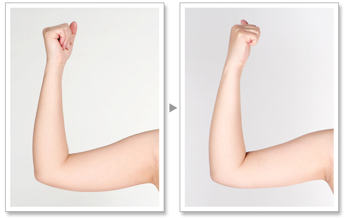 手臂吸脂,对比图,长春好的整形医院