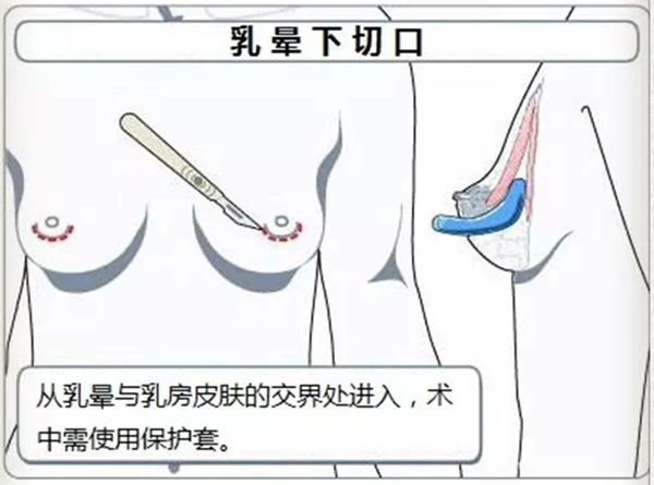 假体隆胸,乳晕切口,长春好的整形医院