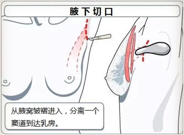 假体隆胸,腋窝切口,长春好的整形医院