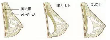 假体,植入位置,手感,长春好的整形医院