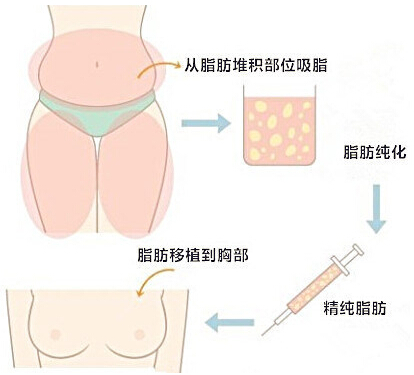 自体脂肪,隆胸,示意图,长春好的整形医院