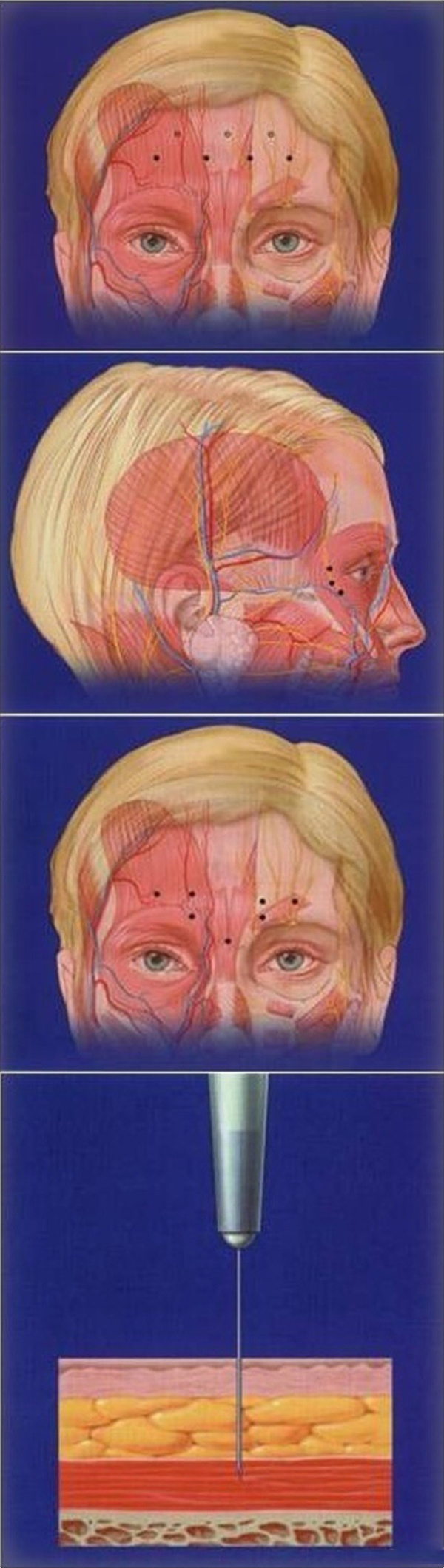 肉毒毒素注射,位置,深度,长春好的整形医院
