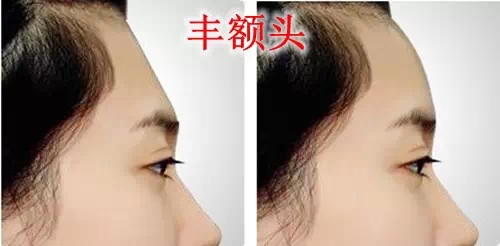 自体脂肪,丰额头,对比图,长春好的整形医院