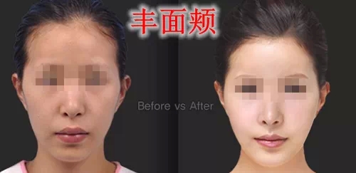 自体脂肪,丰面颊,对比图,长春好的整形医院