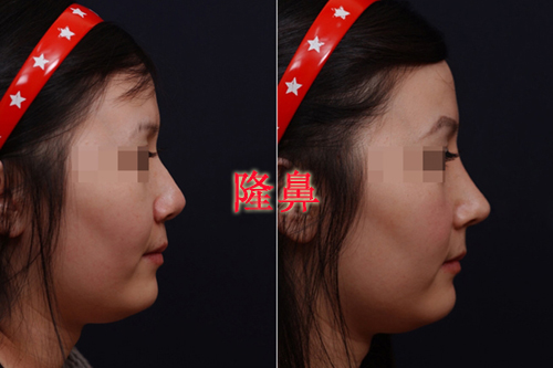 自体脂肪,隆鼻,对比图,长春好的整形医院