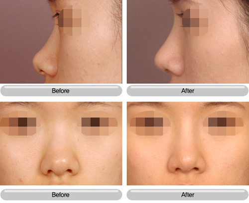 隆鼻失败,修复,对比图,长春好的整形医院