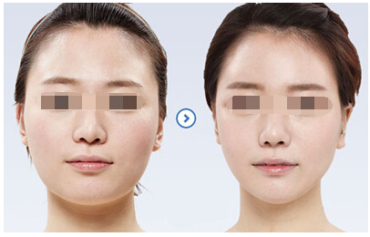 吸脂瘦脸,对比图,长春好的整形医院