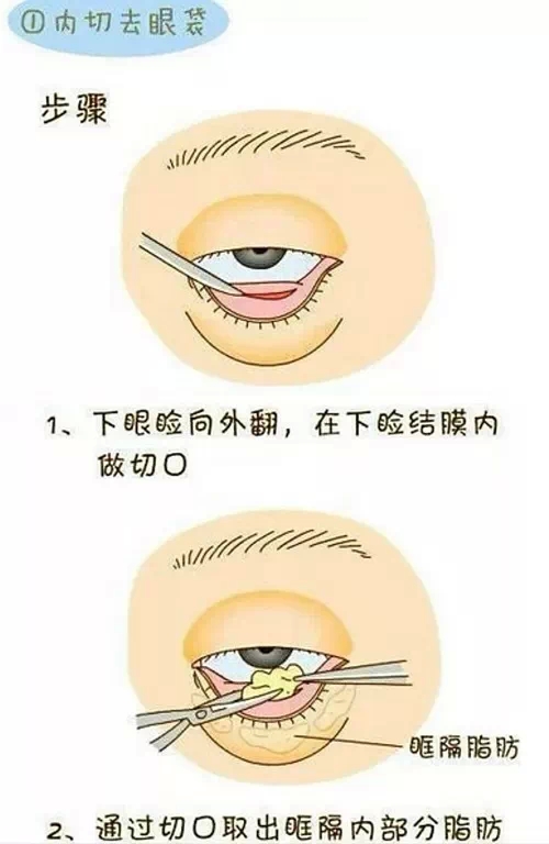 外切法,内切法,长春好的整形医院