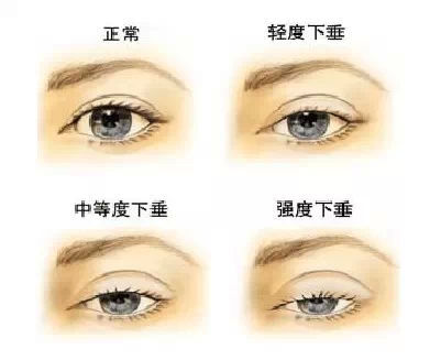 上睑松弛,长春好的整形医院