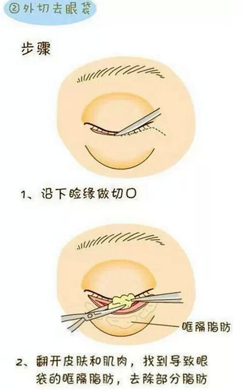 外切法,内切法,长春好的整形医院