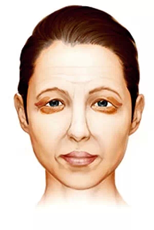 祛眼袋,长春好的整形医院