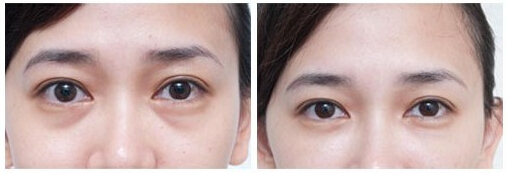 BOTOX,除皱,长春好的整形医院