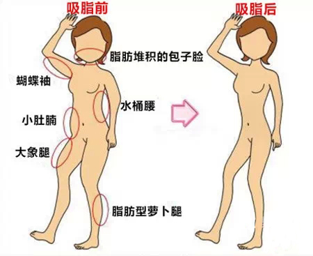 自体脂肪,移植,长春好的整形医院