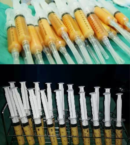 自体脂肪,移植,长春好的整形医院