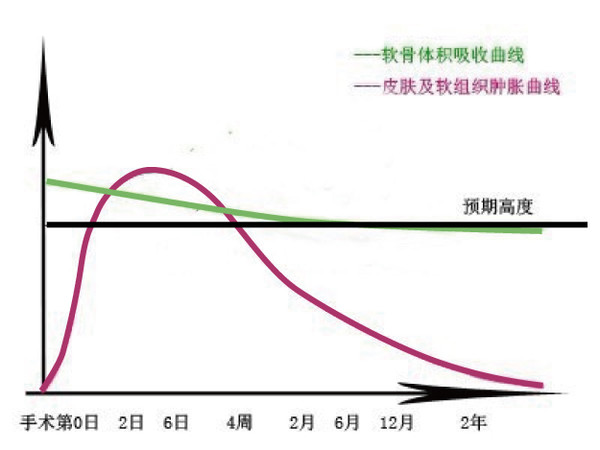 自体软骨,隆鼻,曲线,长春好的整形医院