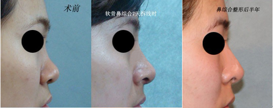 自体软骨,隆鼻,对比图,长春好的整形医院