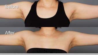 手臂松弛,对比图,长春好的整形医院