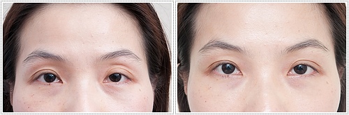 眼窝凹陷,对比图,长春好的整形医院