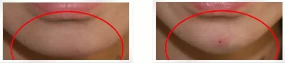 玻尿酸,下巴,对比图,长春好的整形医院