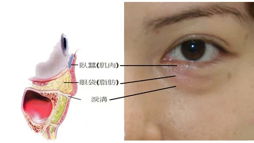 眼袋,卧蚕,区别,长春好的整形医院