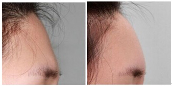 丰额头,对比图,长春好的整形医院