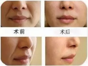 极级音波拉皮,对比图,长春好的整形医院