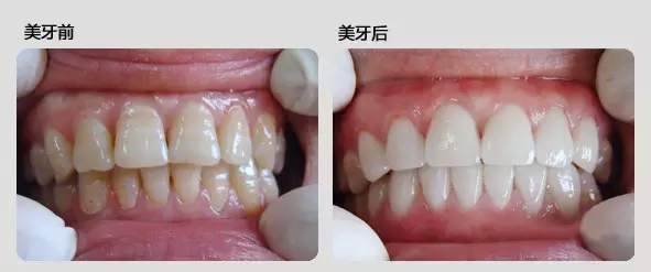 牙齿,冷光美白,对比图,长春好的整形医院