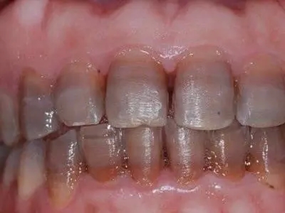 四环素牙,长春好的整形医院