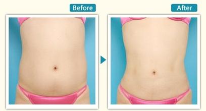 水动力吸脂,对比图,长春好的整形医院