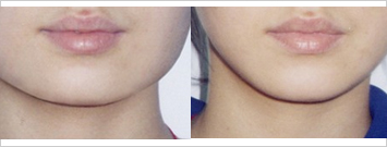 瘦脸,对比图,长春好的整形医院