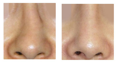 歪鼻,隆鼻,矫正术,长春好的整形医院