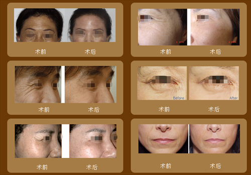 BOTOX,除皱,对比图,长春好的整形医院