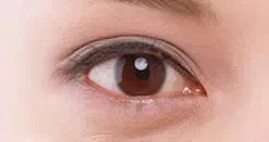 眼袋类型,先天型,长春好的整形医院