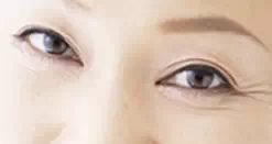 眼袋类型,衰老型,长春好的整形医院