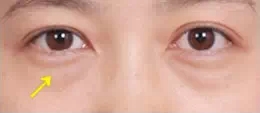祛眼袋,对比图,长春好的整形医院