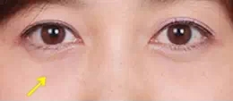 祛眼袋,对比图,长春好的整形医院