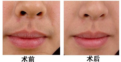 激光脱唇毛,对比图,长春好的整形医院