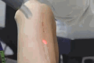 激光祛疤,效果,长春好的整形医院