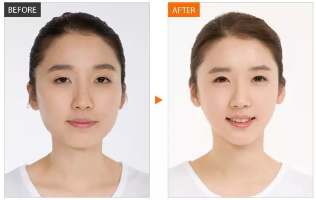 瘦脸针,对比图,长春好的整形医院