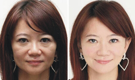 深蓝射频,对比图,长春好的整形医院