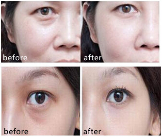 玻尿酸填充,对比图,长春好的整形医院