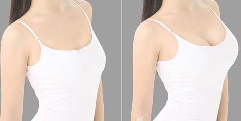 假体隆胸,对比图,长春好的整形医院